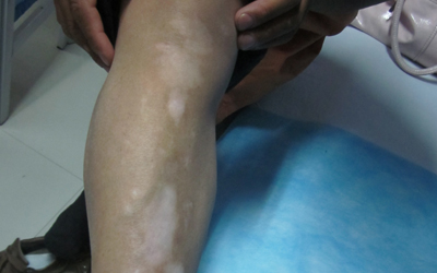 腿上照白斑后不疼不痒大概多少钱