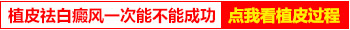 白癜风