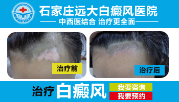 沧州哪里治脸颊白癜风好