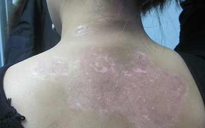 白癜风植皮怎样算是手术成功