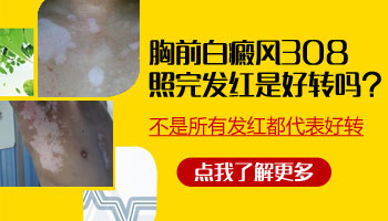 308激光照完白癜风白斑很红怎么回事