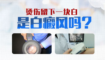 皮肤烫伤后变白会是白癜风吗