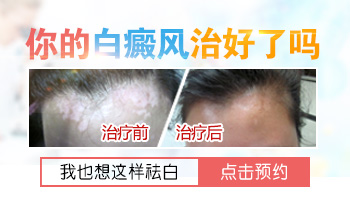 脸部白癜风植皮前后对比图