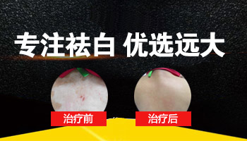 白斑照完激光微红发痒