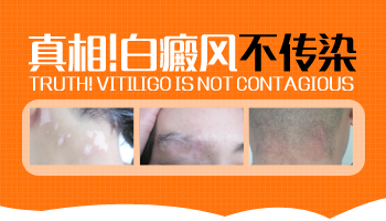 有一小块白癜风传染吗