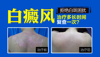 308激光治好白癜风后复发几率多大