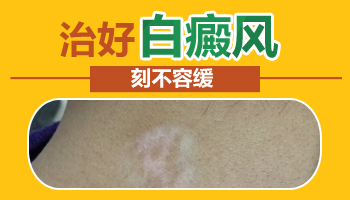 后背有块白斑不治疗会长大吗