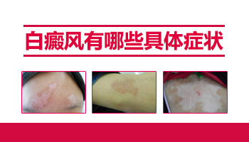 白癜风长什么样子白斑有点扩散怎么办