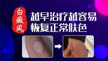 腰部两侧有指甲盖大小的白斑是什么情况