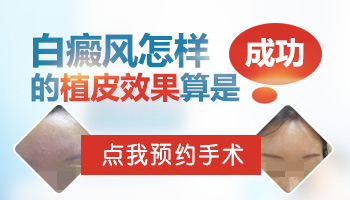 植皮治疗白癜风还会复发吗