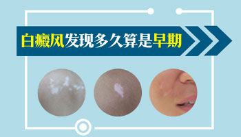 刚刚发现的白斑多长时间能治好