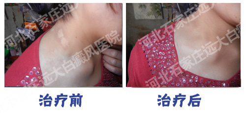 一直吃着白癜风的药物控制不住怎么办