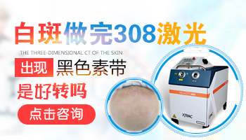 治疗白癜风照308一般多少钱,