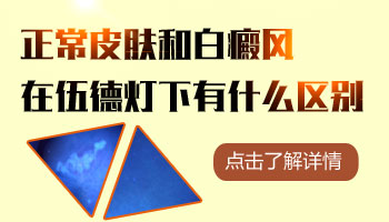 白癜风照伍德灯蓝白色属于什么阶段