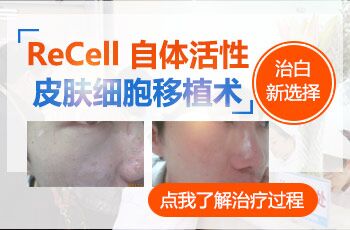 沧州医院recell黑色素细胞再生术治白癜风效果好吗