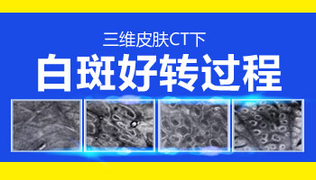 白癜风照308照了几次没效果怎么办