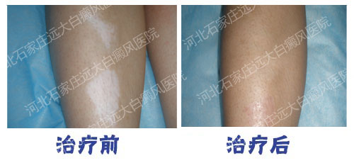 白癜风植皮30平方厘米收多少钱