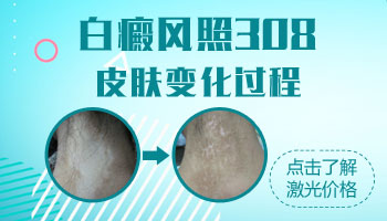 激光治疗面部白癜风后发麻正常吗