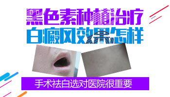 白癜风黑色素种植