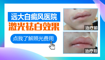 308激光照白癜风好转的过程图片