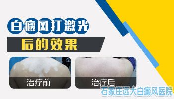 酒精泡补骨脂叶子能治疗白癜风吗