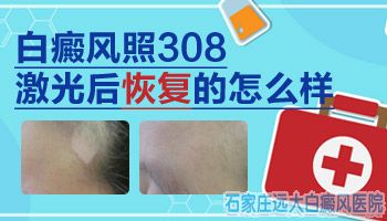 眼睛下边长白斑能照308激光吗