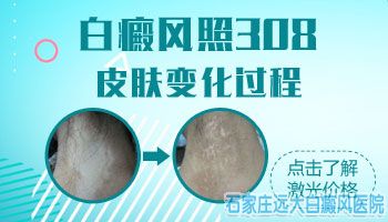 眼睛下边长白斑能照308激光吗