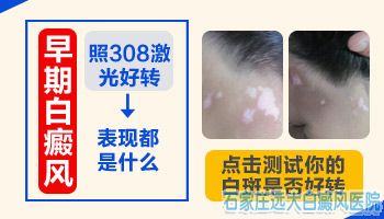 突然长的白癜风怎么治能好