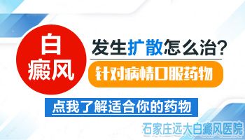 腰部白癜风扩散了用什么方法能控制住