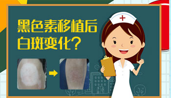 邯郸有没有做白癜风植皮手术的医院