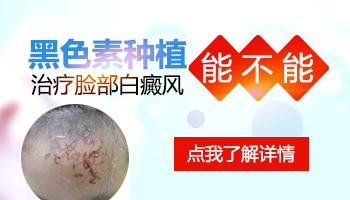 脸部白癜风大概需要多久能治好