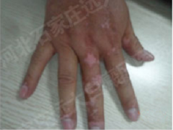 普通医院白癜风实拍图片