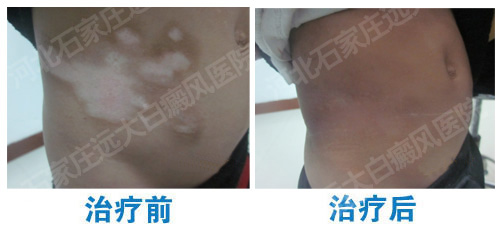 白癜风植皮恢复的图片
