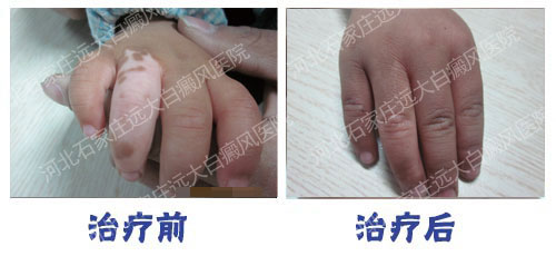 6个月宝宝腿上有白斑图片大全