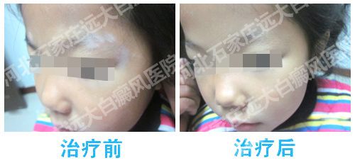 白癜风面部植皮手术前后对比照片
