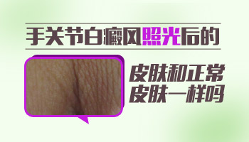 手指末端白癜风有一年多了能治好吗