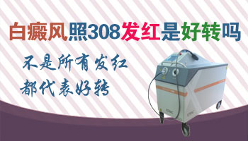 白癜风照光治疗要多久才有效果