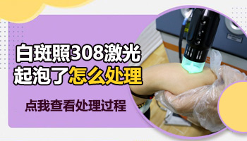白斑做了308激光后变红发痒起水泡怎么办