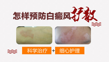 白癜风照308好了以后还会复发吗