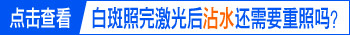 照射完308激光后多长时间能洗澡