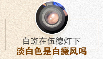 检查是不是白癜风大约需要多少钱