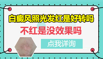 儿童脸部白癜风做完308激光白斑会红几天