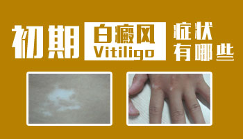 初期手背白癜风照片长什么样子