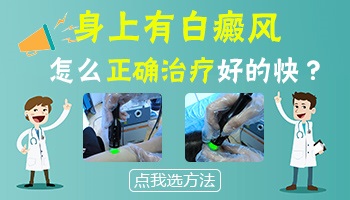 皮肤ct检查白斑会误诊白癜风吗