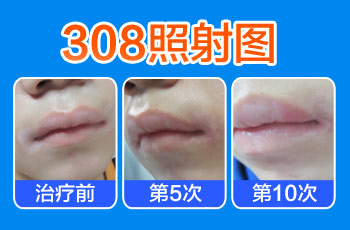 白癜风照308激光一天可以照2次吗 建议多久照一次