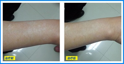 买个308照光仪器多少钱 照白癜风效果对比图