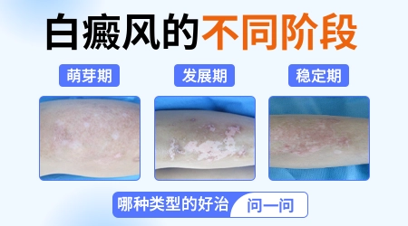不同阶段白癜风白斑的症状