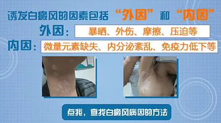 身上长白癜风的常见病因有什么