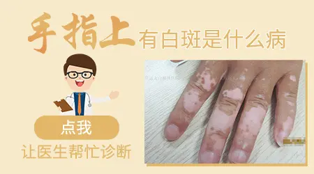手指关节处有白斑是什么病