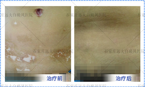 白癜风扎火针为什么越来越严重